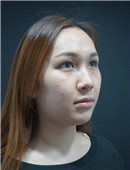 韩国首尔丽格皮肤科-我也有了卧蚕眼 玻尿酸丰卧蚕的效果是这样的