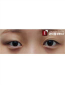 韩国ITEM整形医院-埋线法双眼皮术前术后对比图