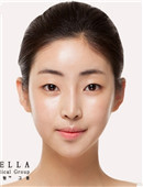 新帝瑞娜整形医院-韩国灰姑娘面部轮廓手术对比图
