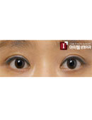 韩国ITEM整形医院-双眼皮修复案例对比图