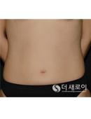 韩国seroi整形医院-腹部吸脂对比日记
