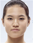 真人分享：我在韩国ID医院矫正面部不对称，歪下巴经过！