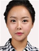 新帝瑞娜整形医院-韩国灰姑娘整形医院下颌角手术对比案例图