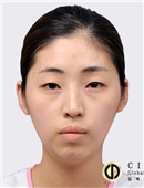 新帝瑞娜整形医院-韩国灰姑娘面部轮廓手术对比图