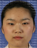 韩国BK医院眼部切开法+上睑下垂提肌矫正术对比