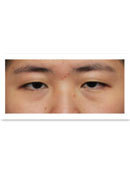 韩国BIO曹仁昌埋线双眼皮术前术后对比