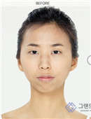 韩国高兰得整形外科凸嘴手术前后对比案例图_术前