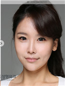 韩国高兰得整形外科眼鼻+轮廓手术对比案例