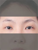 双眼皮修复术前术后对比