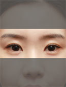 韩国原辰双眼皮线条修复前后对比