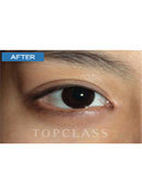 韩国顶级整形-韩国TopClass整形外科开内眼角案例图