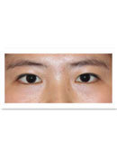 韩国BIO曹仁昌埋线双眼皮术前术后对比