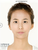 韩国高兰得整形外科凸嘴手术前后对比案例图_术后
