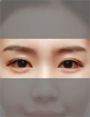 韩国原辰整形外科-韩国原辰双眼皮线条修复前后对比