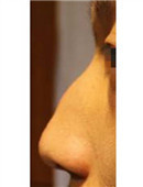 鼻部整形对比案例_术前