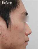 韩国mvp整形外科鼻整形对比案例