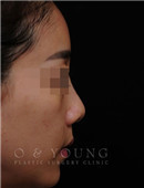 韩国onyoung整形外科-鼻整形对比案例