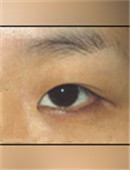 韩国枓翰-韩国枓翰整形外科双眼皮手术对比日记