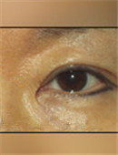 韩国枓翰整形外科眼睑修复手术对比日记