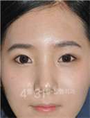 韩国4月31日整形外科眼修复对比日记_术后