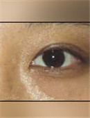 韩国枓翰整形外科眼部修复对比日记