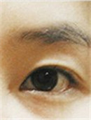 韩国原辰整形外科-韩国原辰眼部修复手术对比案例