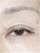 韩国原辰整形外科-眼部修复对比案例