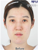 韩国FACE-LINE整形-面部轮廓对比案例