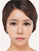 韩国灰姑娘整形外科鼻部修复对比案例