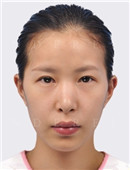 韩国灰姑娘整形外科眼部修复对比案例