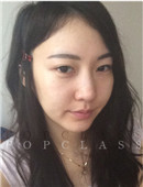 韩国顶级整形-韩国topclass隆胸+鼻整形真实整形经历记录