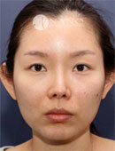 韩国NANO整形外科鼻修复真实日记图