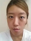 韩国必妩整形医院-在必妩整形医院做完面部轮廓+眼鼻综合手术后的我
