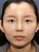 韩国NANO整形外科鼻修复真实案例图