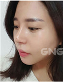 韩国GNG整形医院隆鼻案例恢复全过程