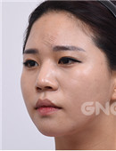 韩国GNG整形医院隆鼻案例恢复全过程_术前