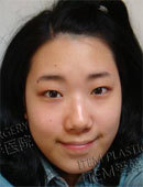 韩国ITEM整形医院-在爱婷做完眼鼻手术和脂肪填充后的恢复过程