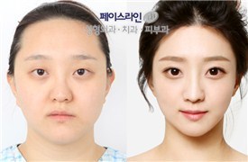 韩国整形医院face-line的V-line案例怎么样？