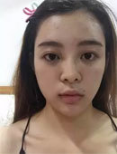 韩国DA整形外科-韩国DA整形外科做眼鼻和脂肪移植效果怎么样？