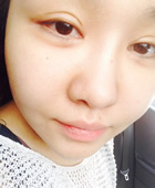 韩国美佳双眼皮修复1个月 眼睛做失败的妹子进来看看_术前