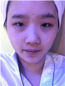 韩国ID整形医院双眼皮+隆鼻手术案例恢复全过程