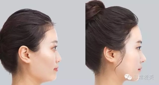 韩式隆鼻案例对比图