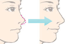 自体软骨隆鼻所用的手术材料有哪些？