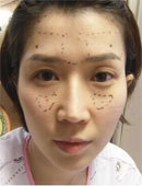 在韩国灰姑娘做完隆鼻手术的恢复过程