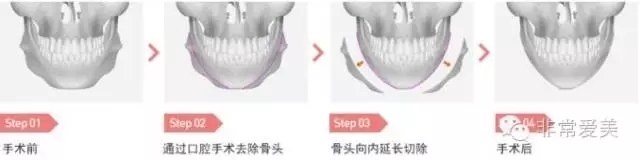 长曲线下颌角截骨手术过程示意图