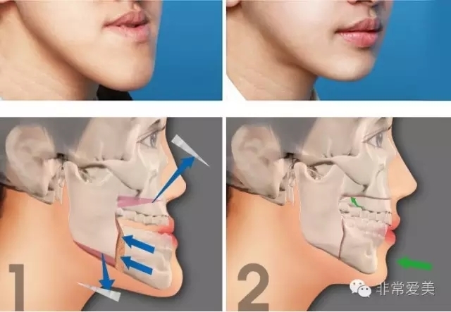 手术方法是将下颚后部竖直切开,通过将下颚向后移动的方式来调整关节