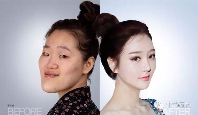 韩国灰姑娘整形外科双鄂手术案例对比