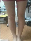 韩国灰姑娘整形医院-在灰姑娘做完腿部吸脂手术 小粗腿不见了