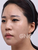 韩国GNG整形-她在GNG只做了鼻子却改变了人生！
