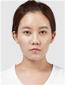 韩国TL整形外科蒜头鼻矫正手术对比案例_术前